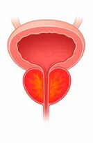 Възпаление на простатната жлеза